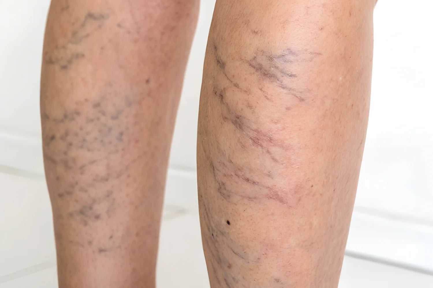 Chronic Venous Insufficiency: 7 Tips for Self-Care product