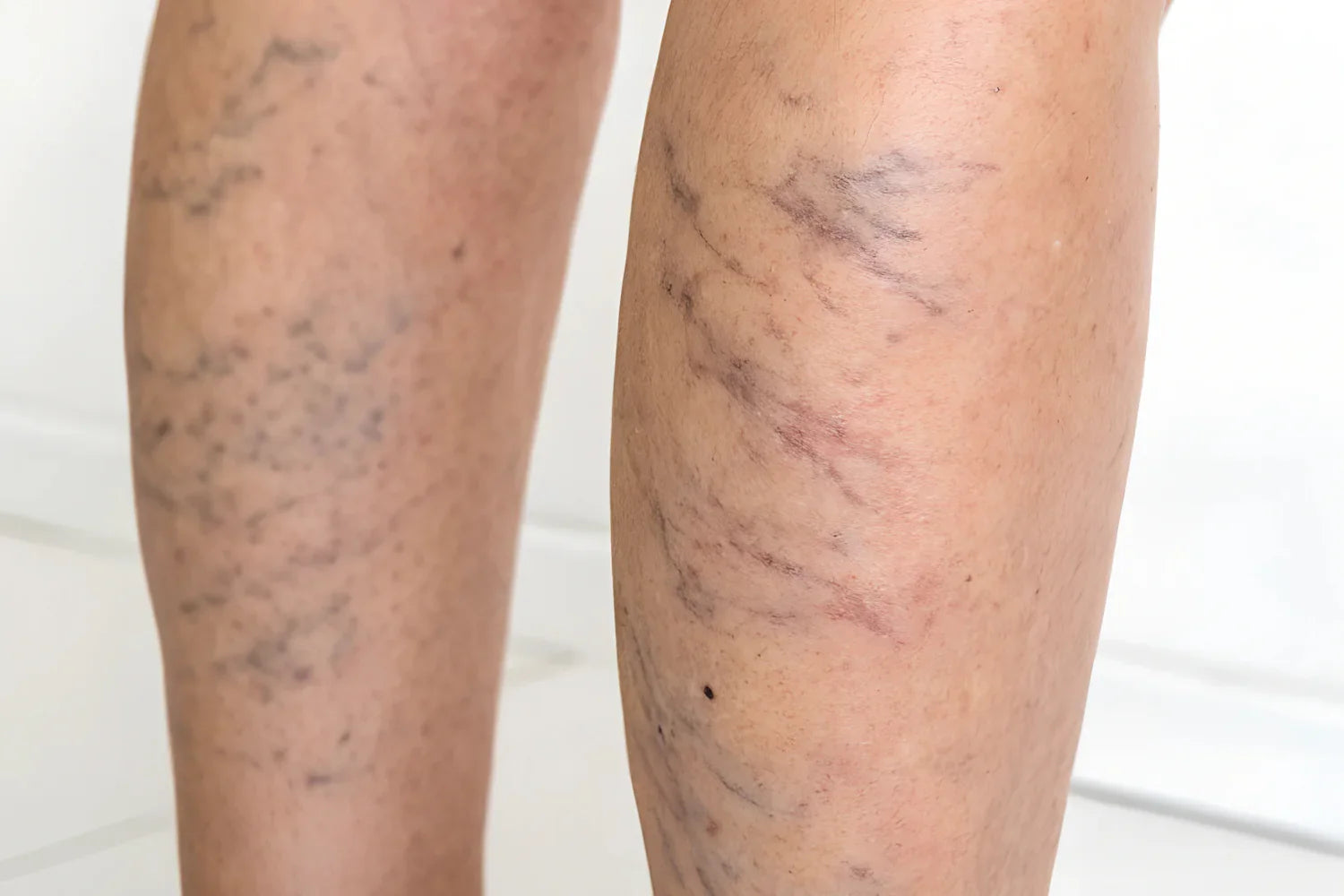 Chronic Venous Insufficiency: 7 Tips for Self-Care product