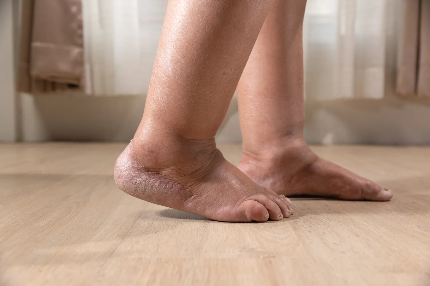 Compression Socks for Edema: What To Know product