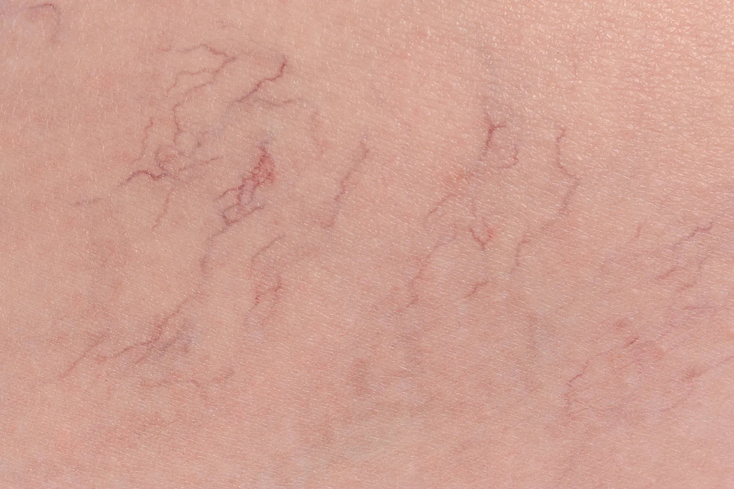 Do Spider Veins Go Away on Their Own? product