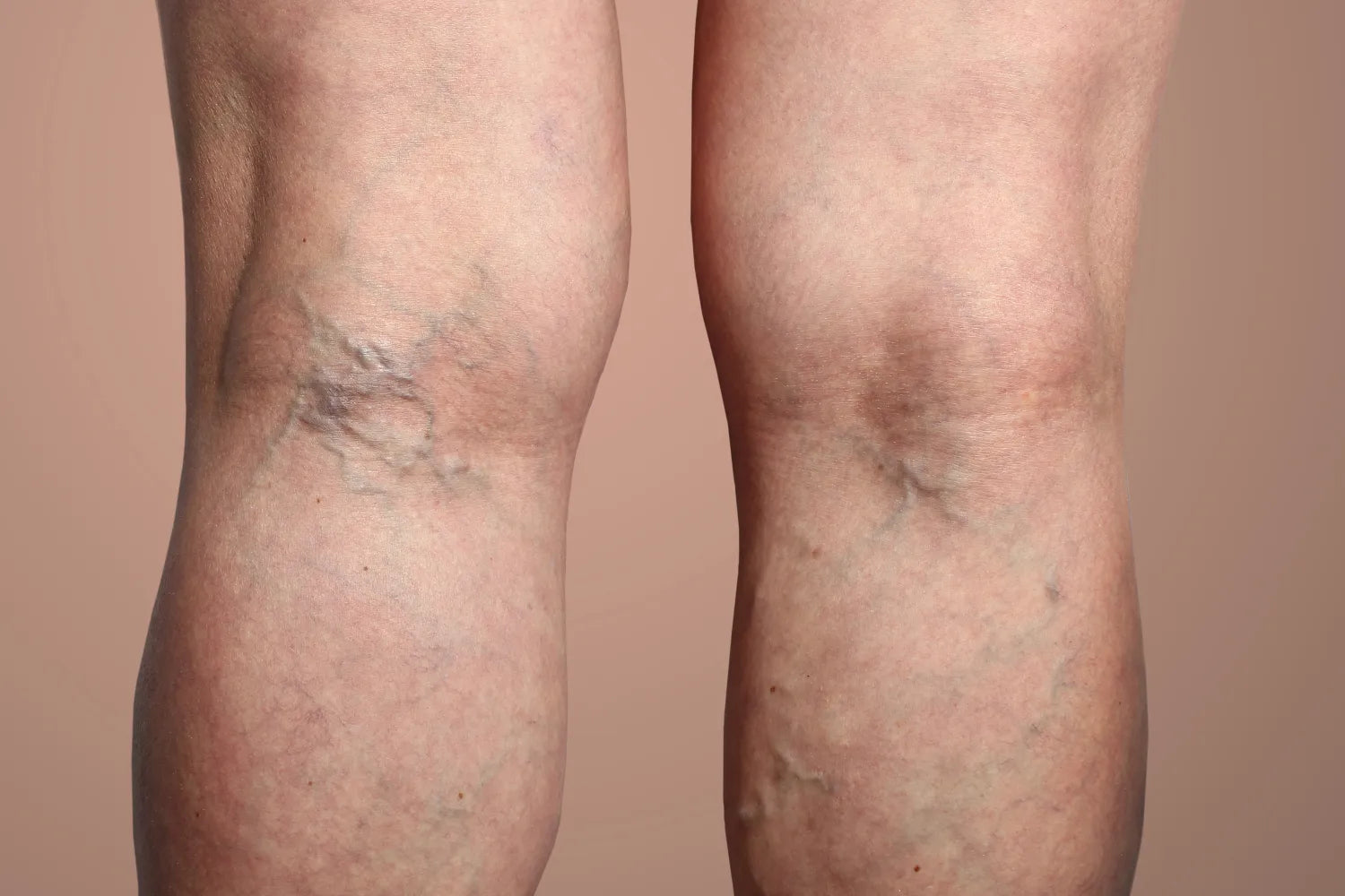 Varicose Veins vs. Spider Veins: The Differences product