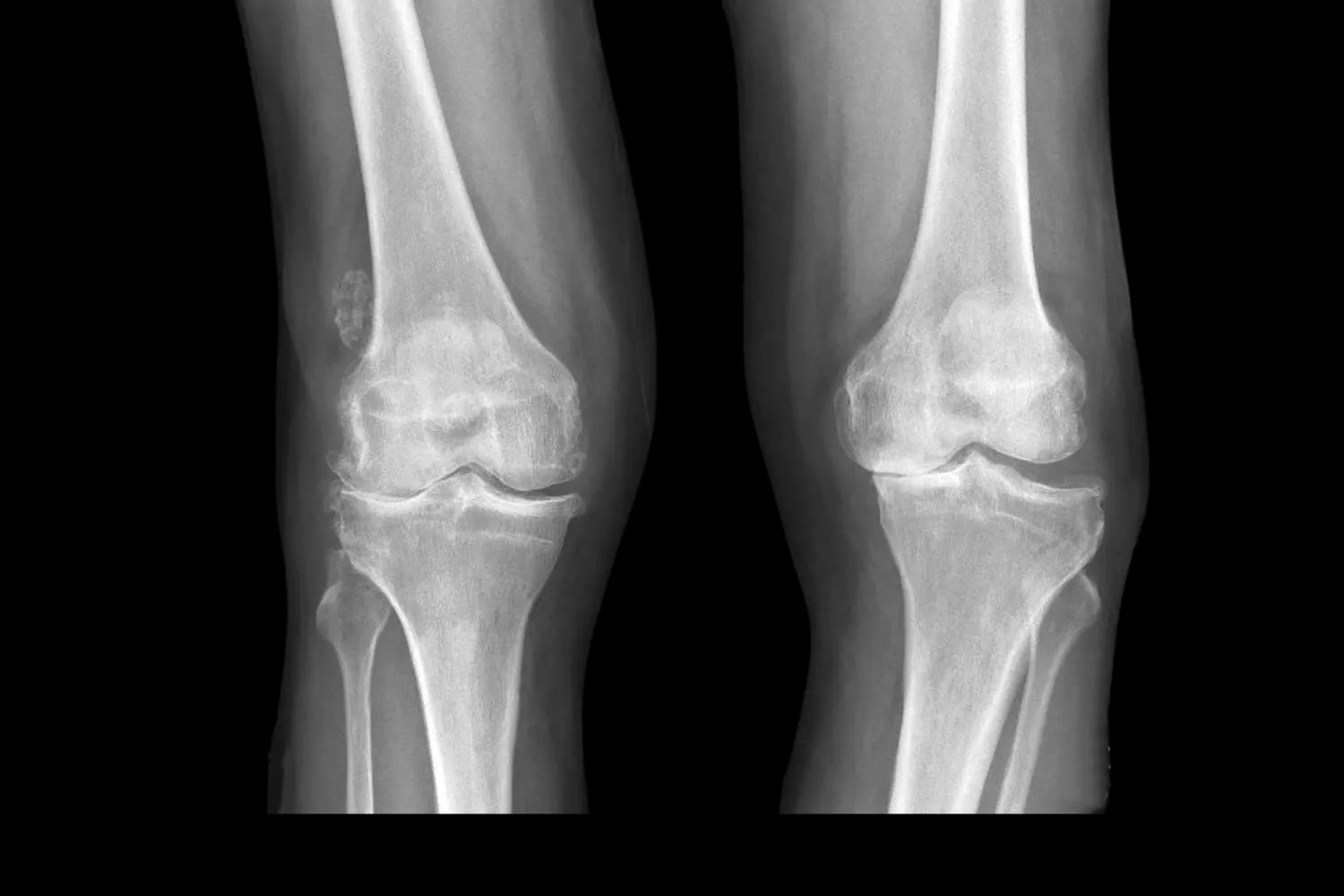 Knock Knees: What It Is & What You Can Do About It product
